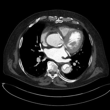 Aortic dissection | Radiology Reference Article | Radiopaedia.org