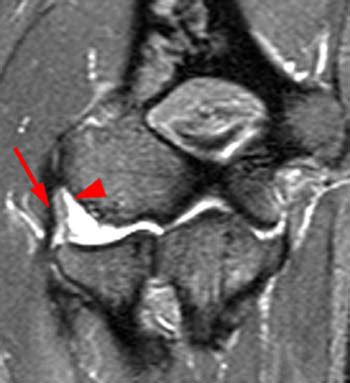 Lateral Ulnar Collateral Ligament - Radsource