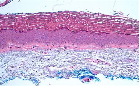 Large-Cell Acanthoma - Dermatology Advisor