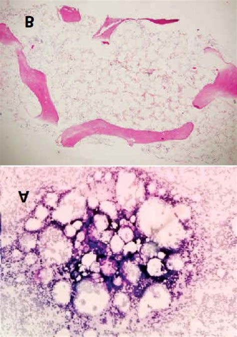 Bone marrow aspiration and trephine biopsy of the patient. A) Bone... | Download Scientific Diagram