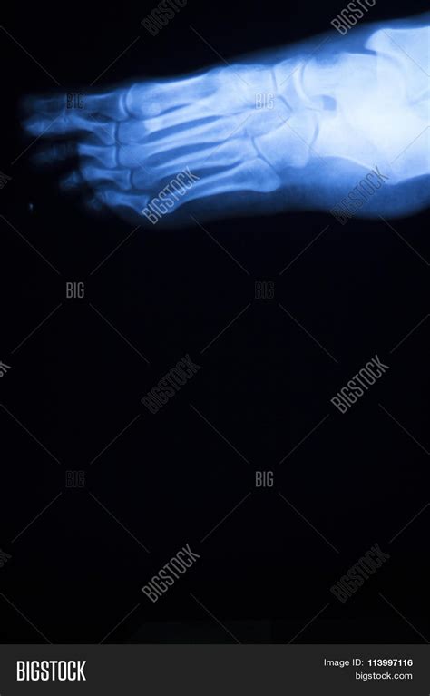 Foot Toes Injury X-ray Image & Photo (Free Trial) | Bigstock