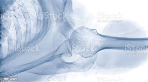 Xray Shoulder Joint Shoulder Transaxillary View For Diagnosis Fracture Of Shoulder Joint Stock ...