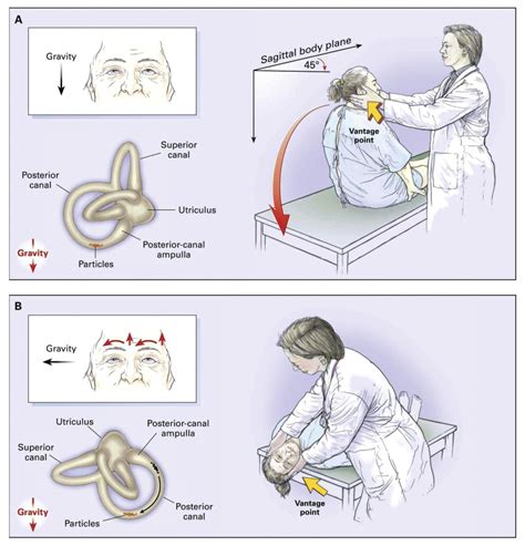 Dix-Hallpike Test for Vertigo | New Health Advisor