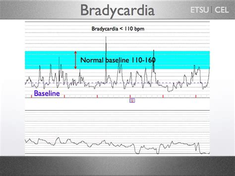 Fetal Heart Rate - Fetal Heart Monitoring