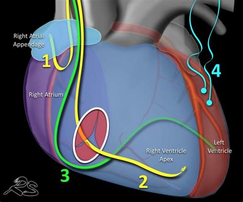 Biventricular Pacemaker Chest X Ray