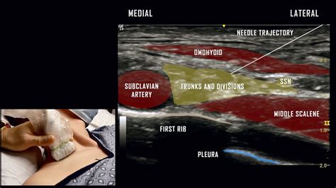 Supraclavicular Block // Ultrasound Anatomy Review - YouTube