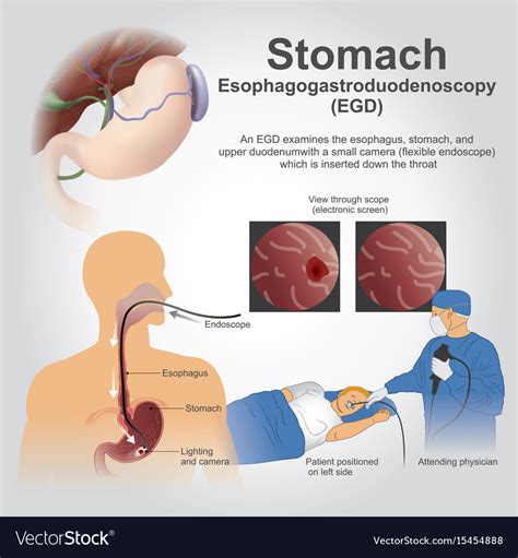 Egd stomach Royalty Free Vector Image - VectorStock