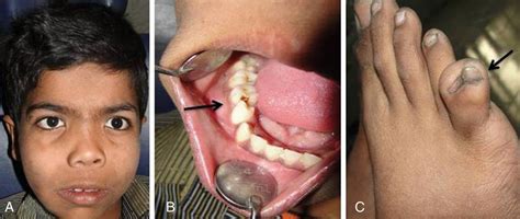 Gorlin Syndrome Symptoms