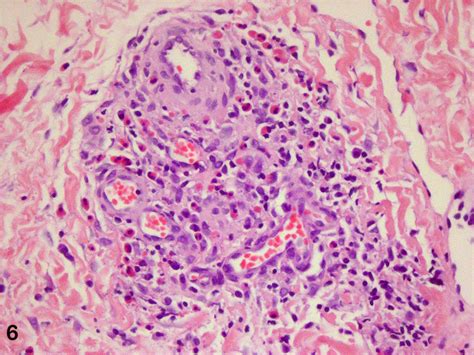 Angiolymphoid hyperplasia with eosinophilia; Kimura Disease; Granuloma, Pseudopyogenic