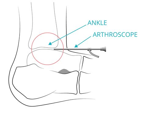 Ankle Arthroscopy | Wiltshire Foot and Ankle