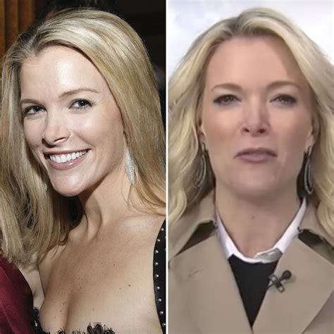 Has TV Star Megyn Kelly Gotten Plastic Surgery? Experts Weigh In!