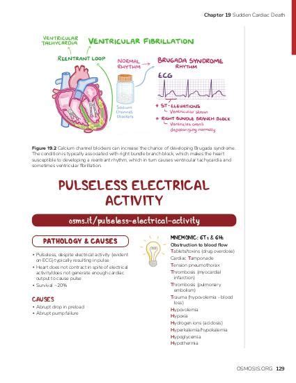 Brugada syndrome: Video, Causes, & Meaning | Osmosis