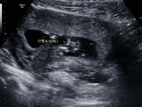 EARLY gender ultrasound thread | BabyCenter