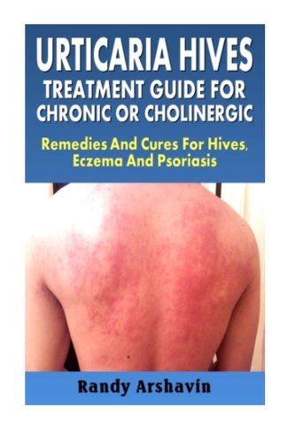 Urticaria Hives : Treatment Guide For Chronic Or Cholinergic: Remedies And Cures For Hives ...