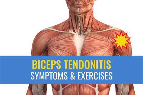 Biceps tendonitis treatment: Causes, symptoms, exercises, and recovery ...