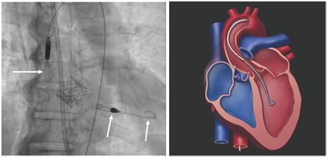 Impella Pump Support – provides hemodynamic support during protected ...