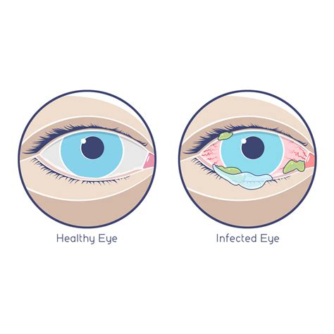 Midtown Optometry - 3 Types of Pink Eye and Treatment For Them