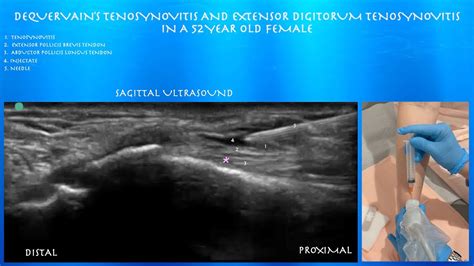 Ultrasound Guided Injection for De Quervain's Tenosynovitis - YouTube