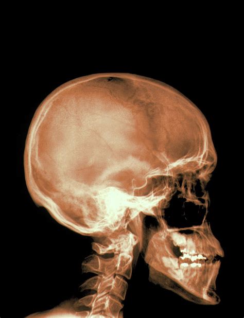 Skull X-ray Photograph by Alfred Pasieka/science Photo Library - Fine Art America