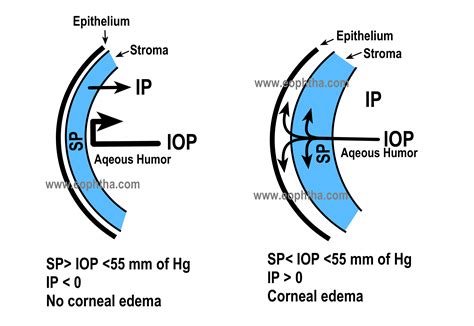 Causes Of Corneal Edema