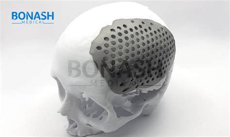 Cranial Custom Made Implant - Bonash Medical - Patient Specific Implants