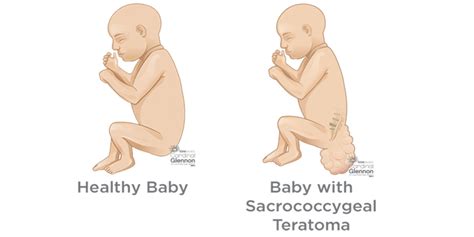 Sacrococcygeal Teratoma Types