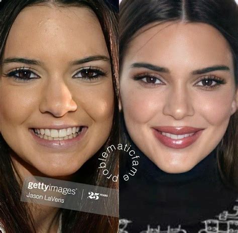 kendall jenner | Rhinoplasty nose jobs, Kendall jenner nose job ...