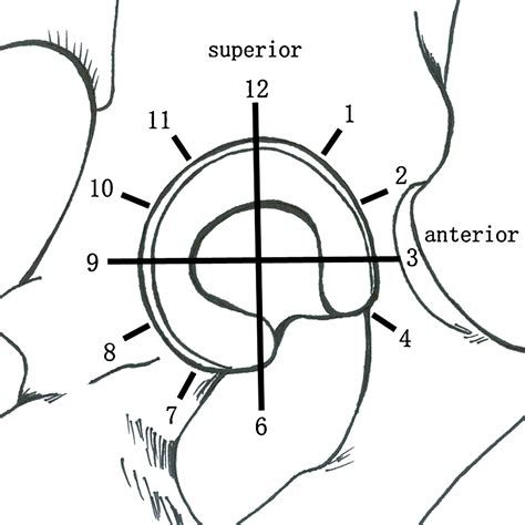 3.0T conventional hip MR and hip MR arthrography for the acetabular labral tears confirmed by ...