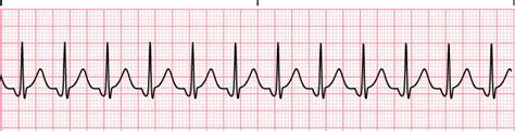 junctional-tachycardia - Cardiac Sciences Manitoba