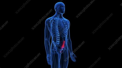 Animation of a fracture of the hip bone - Stock Video Clip - K012/0587 ...