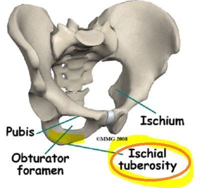 Pin on Ischial Bursitis