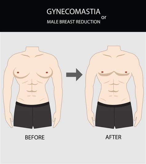 Gynecomastia In Teens: Causes, Signs, Diagnosis & Treatment