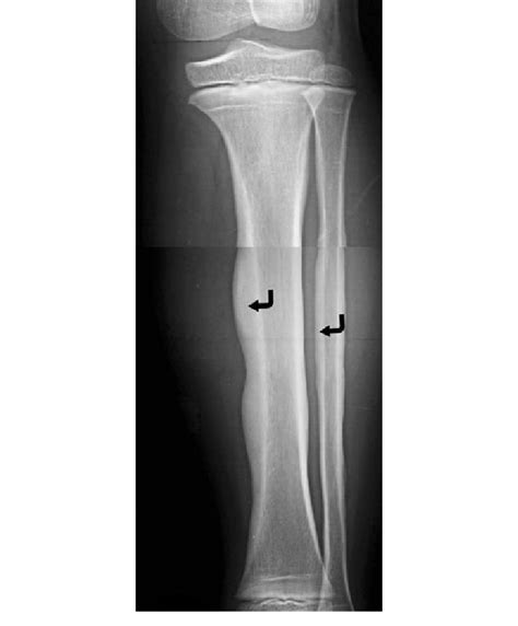 Cortical thickening (curved arrows) at the tibial and fibular diaphysis... | Download Scientific ...