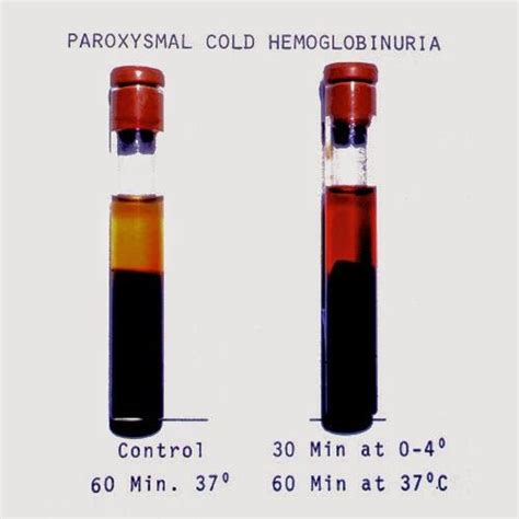 Hemoglobinuria Causes - Ashley Westerman Bruidstaart