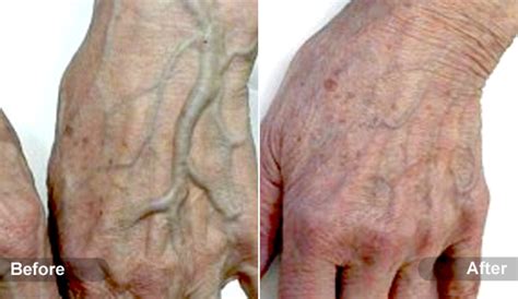 St. Louis Facial and Hand Spider Veins Treatment | St. Louis Laser Vein Center