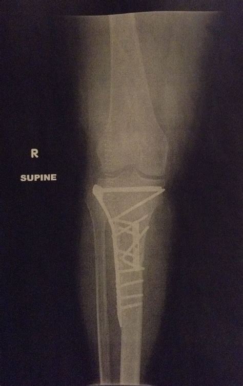 Tib fib Fracture post op day 10 | Post op, Fracture, Post