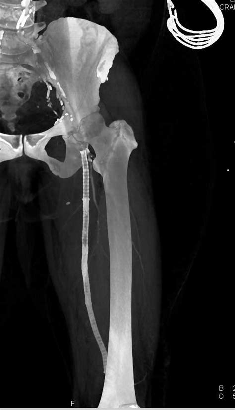 Occluded Left Femoral Artery with Stent Graft - Vascular Case Studies - CTisus CT Scanning