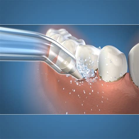 Waterpik Pik Pocket Replacement Tips, Designed to Clean Periodontal ...