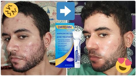 My 4 Months Acne Journey Using Differin Gel! before and after - YouTube