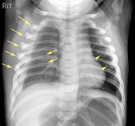 RiT radiology: Non Accidental Injury (NAI): Rib Fractures