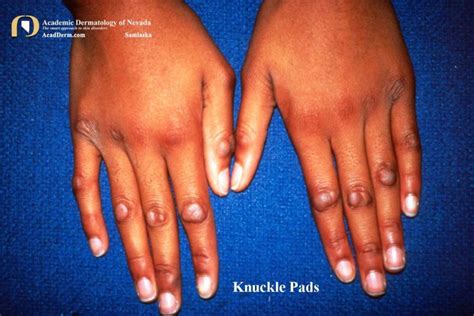 Knuckle Pads: Heloderma... - Academic Dermatology of Nevada