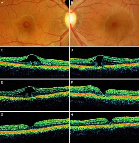 Macular hole causes, symptoms, diagnosis, treatment & prognosis