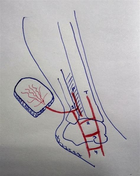 Anatomy of the vessels around the ankle. P: Peroneal artery; T:... | Download Scientific Diagram