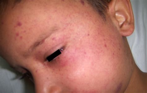 What Are Petechiae and Causes of Petechiae?