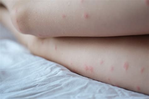 Blackheads On Legs: Causes, Prevention & Blackhead Removal Tips