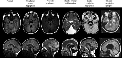 Disorders of Cerebellar and Brainstem Development | Clinical Gate