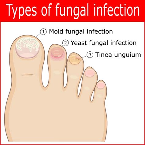 Blog 20 - What Kills Toenail Fungus Instantly?