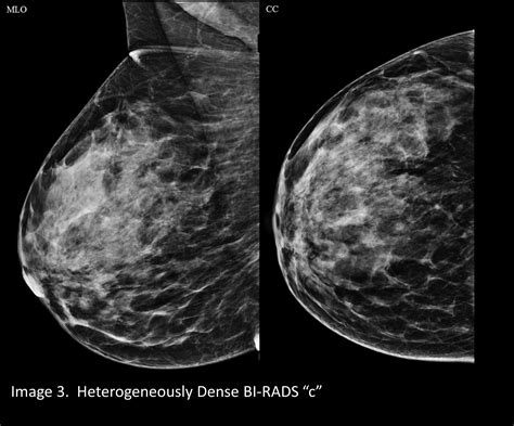 Your patient got a dense breast notification with her mammogram report: What are you supposed to ...