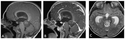 Cerebral Peduncle Mri