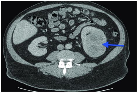 A CT scan image showing a 7 cm left kidney mass. | Download Scientific Diagram